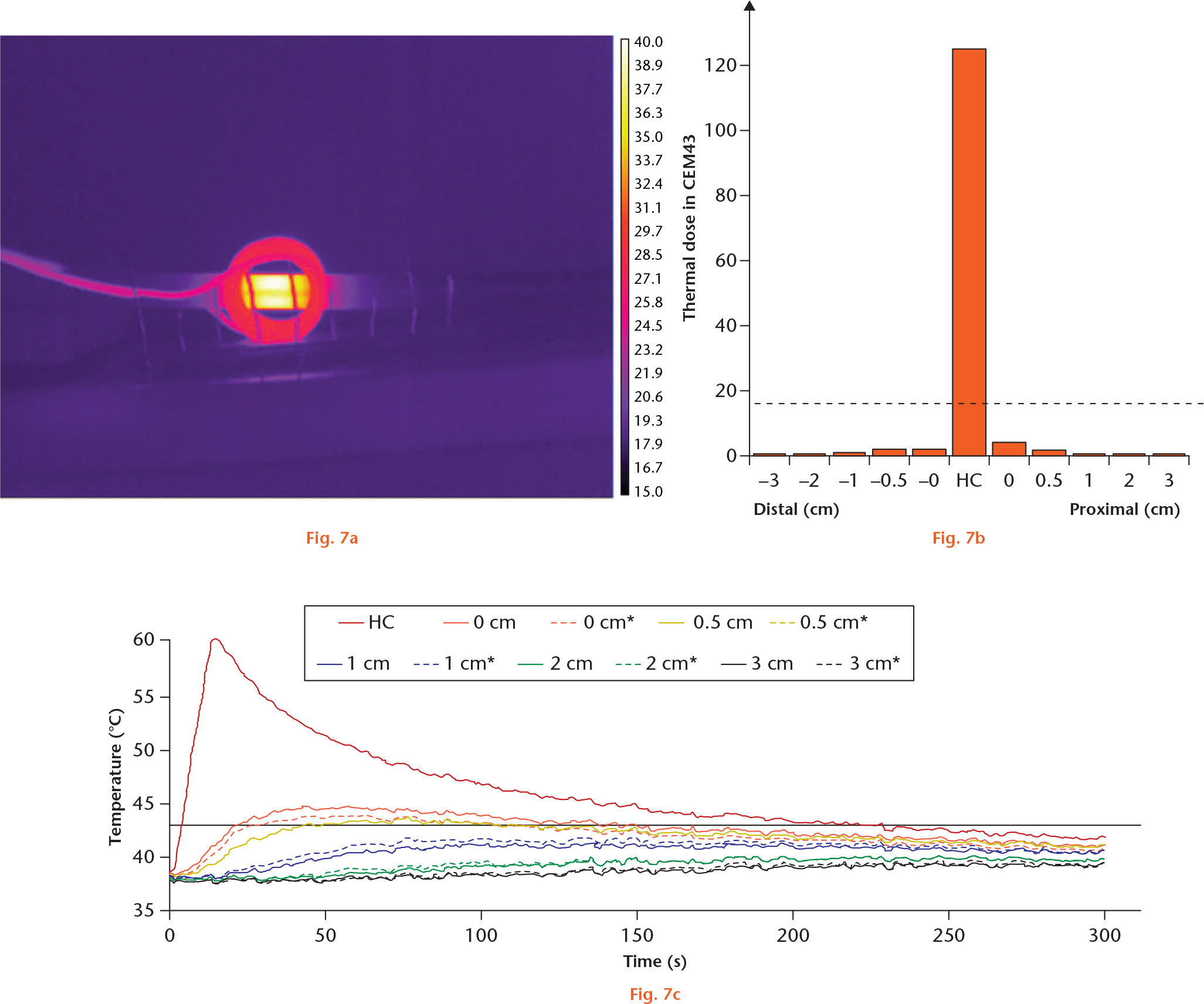  
            Segmental induction heating of intramedullary (IM) nail. a) A thermal image from a thermal camera showing selective heating. The vertical lines have 1 cm spacing. b) A graph showing thermal dose in CEM43 at several distances from the heating centre (HC). The dashed line represents 16 CEM43, the threshold for necrosis of bone. c) A graph showing the temperature at several distances from the HC during the segmental induction heating and thereafter. Dashed lines indicate distal direction.
          