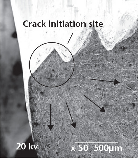 Fig. 5 
            Fractographic analysis. The circle indicates the region of the cracks initiating at the tip of the first thread of the screw hole. The arrows represent the crack propagation direction.
          