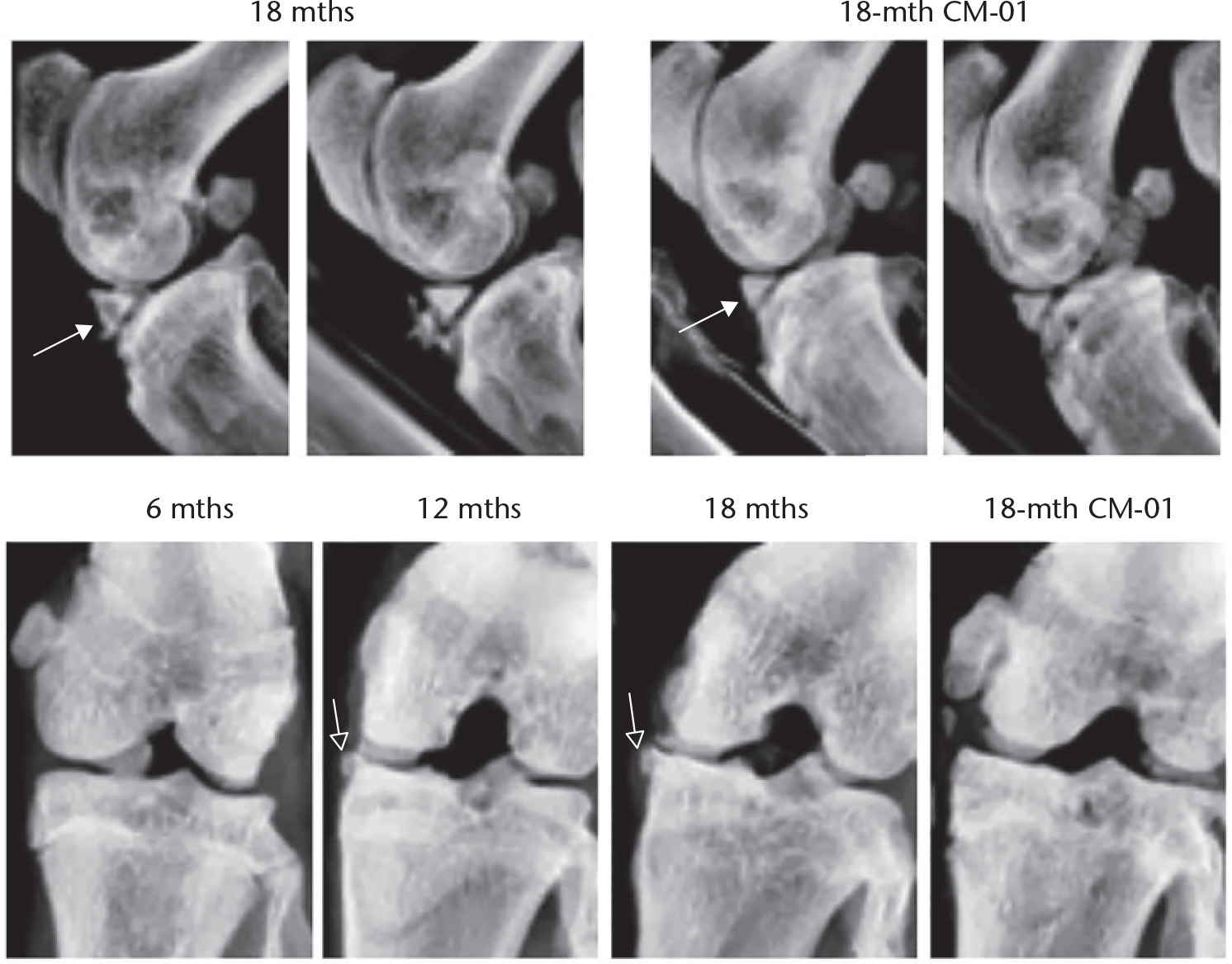 Fig. 1 
            Radiographs of knee joints. Carolinas Molecule-01 (CM-01) reduced the sizes of calcified anterior horn of menisci and the sizes of osteophyte. Solid arrows, calcified anterior horn of the menisci; hollow arrows, osteophytes.
          