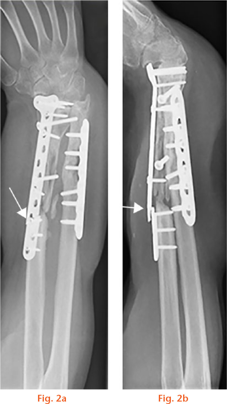  
          Atrophic pseudarthrosis of the radial diaphysis in a 17-year-old girl. a) Anteroposterior and b) lateral radiograph of the right forearm showing plate breakage at the site of nonunion (arrow and arrowhead). Also seen is an impingement of the carpus due to flexion contracture and a radiocarpal collapse.
        