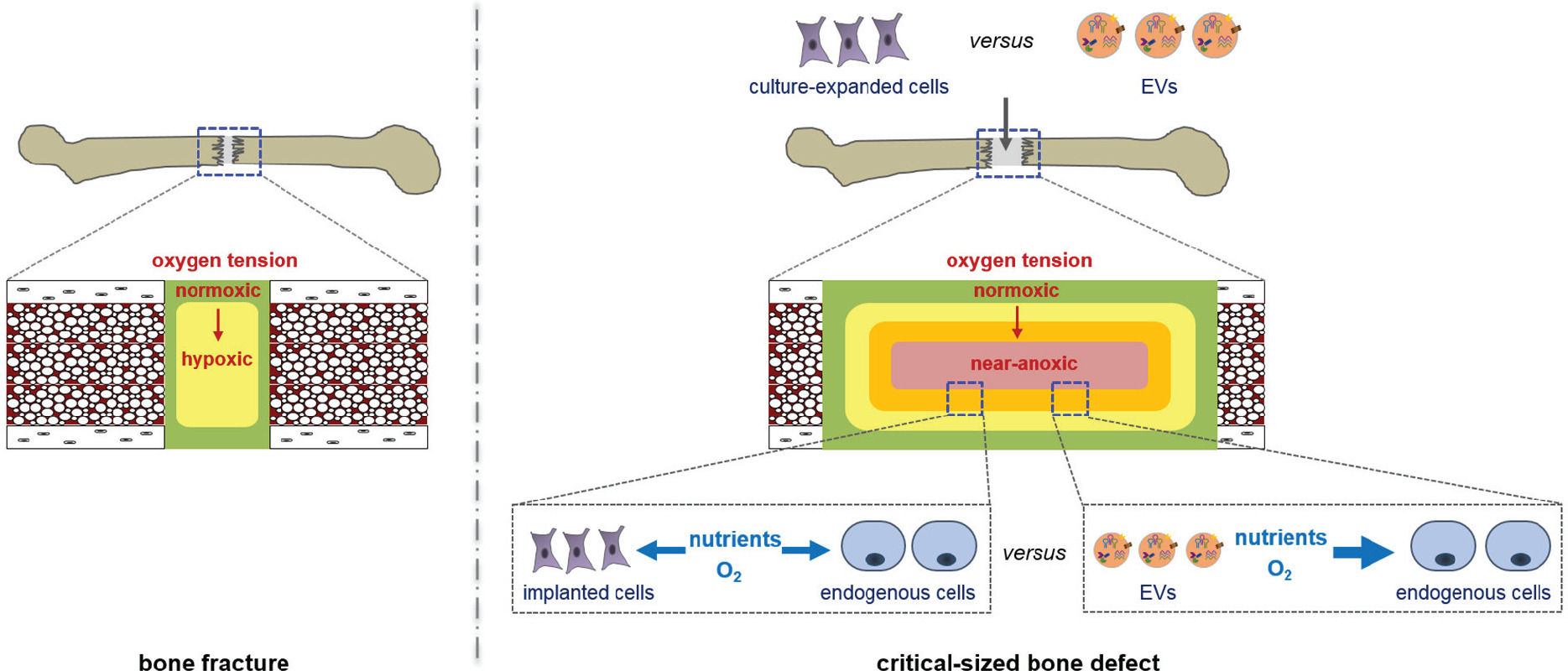 Fig. 3 
          Diagram showing the potential advantage of extracellular vesicles (EVs) within a large bone defect microenvironment. As opposed to simple fractures, bone defects beyond a critical size are characterized by severe nutrient deficiency and near-anoxia within their core. While exogenous cells implanted into these defects may secrete pro-regenerative factors, they also compete with endogenous repair cells migrating into the defect for scarce oxygen and nutrients. In contrast, the same pro-regenerative signals packaged within EVs would not necessarily tax the defect for nutrients and oxygen, potentially permitting enhanced repair by endogenous cells.
        