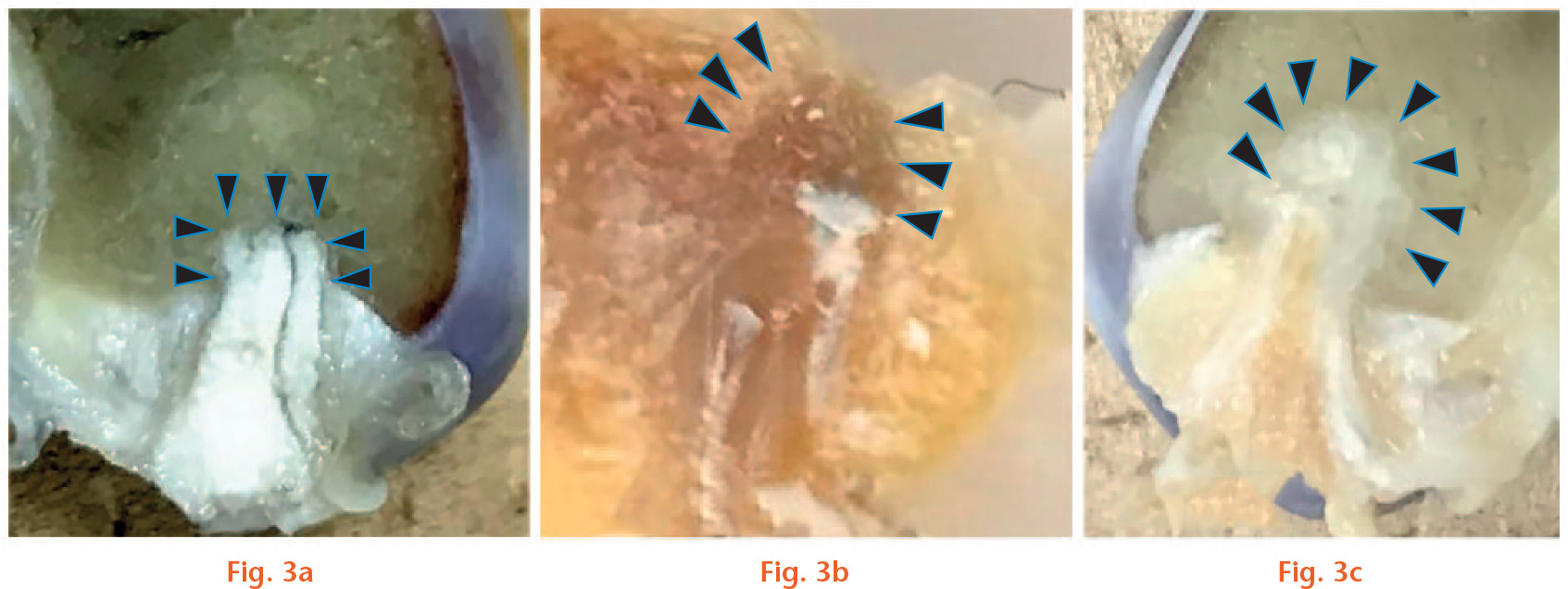  
            Sections along the tunnel axis after fixation in paraformaldehyde are shown (cut at the centre of the cross section of the graft): a) in the knees from the Socket group (right side), grafts were in close contact with the socket at both four and eight weeks. The graft end was quadrangular, fitting into the end of the socket; b) at four weeks, new bone formation in the tunnel above the graft end was observed, however, the boundary between the surrounding cancellous bone was clearly distinguishable; c) at eight weeks, the graft end in the Tunnel group was loop-shaped (semi-elliptical) at the time of insertion into the tunnel, and the newly formed bone was replaced with cancellous bone-like tissue which had integrated into the surrounding cancellous bone when the specimen was cut at the appropriate position. Arrowheads in (a), (b) and (c) indicate the contour of the tendon/bone interface.
          