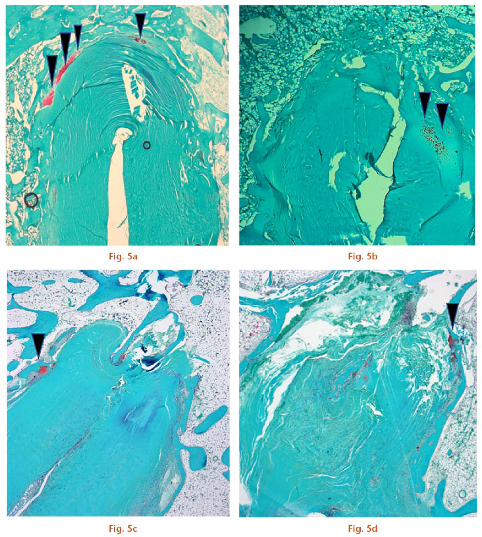  
            Photomicrographs of the tendon/bone interface with Safranin O staining (magnification × 25). Cartilage tissue is indicated by the arrowheads. a) The Socket group had more cartilage tissue than b) the Tunnel group at four weeks. Cartilage tissue was reduced at eight weeks in both c) the Socket group and d) Tunnel group (scale bars, 1.0 mm).
          