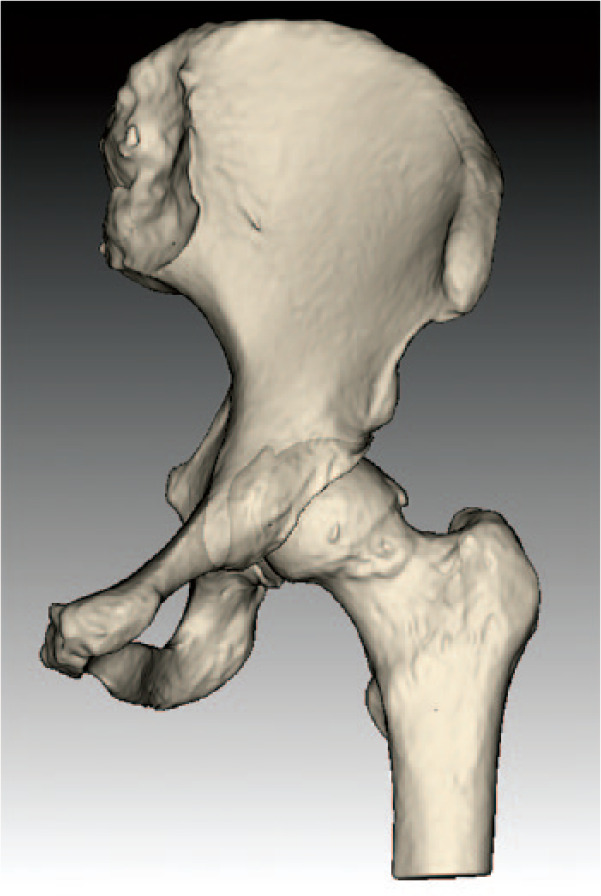 Fig. 1 
          Image showing the segmented models of the pelvic and the femur bone.
        