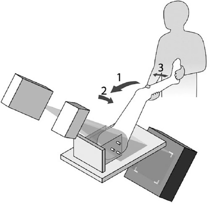 Fig. 2 
            Setup of the radiostereometric equipment. The radiograph tubes are positioned with a 20° mediolateral and 45° cranio-caudal tilt. The calibration box is placed in a 45° angle beneath the hip joint. The arrows indicate the movement 1) flexion, 2) adduction and 3) internal rotation. Reprinted with courtesy from Hansen et al.6
          