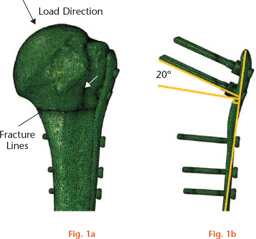 
          Examples of the finite element model for evaluation of the principal compressive bone strains at the tip of the four proximal screws of the prototype plate: a) a virtually instrumented specimen after anatomical reduction of the fragments. The red arrows denote the fracture lines and the yellow arrow the direction of loading as adapted from Bergman et al;24 b) prototype plate with 20° screw angle configuration.
        