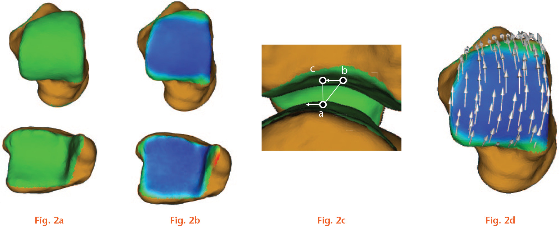  
            a) Subchondral bone surfaces of the talus and tibia in the tibiotalar joint were identified. b) Distance maps were calculated and colour-coded on the surfaces. c) A surface relative velocity vector (SRVV) was calculated for each point in the surface using the vectors to the closest points in two consecutive frames (ac→ − ab→), where b and c represent the closest points in the previous and current frames, respectively. d) SRVVs were calculated for sample points in the region of interest.
          