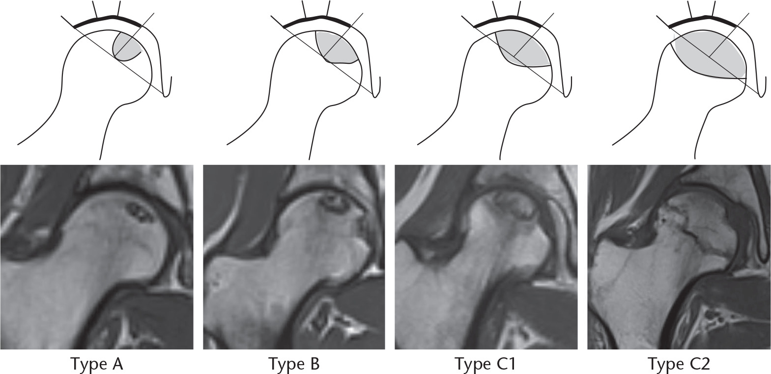 Fig. 1 
          Schematic representation of T1-weighted MRIs of the 2001 revised Japanese Investigation Committee classification system20 based on type. The classification schema comprises four types (A, B, C1, and C2). Type A involves the smallest osteonecrotic lesions of the four types (present only in the medial one-third, or less, of the weightbearing surface). Type B involves osteonecrotic lesions present in the medial two-thirds, or less, of the weightbearing surface. Type C1 lesions are characterized by an osteonecrotic zone that spans more than the medial two-thirds of the weightbearing surface at the acetabular edge. Type C2 involves the largest osteonecrotic zone that spans more than the medial two-thirds of the weightbearing surface and exceeds the acetabular edge.
        
