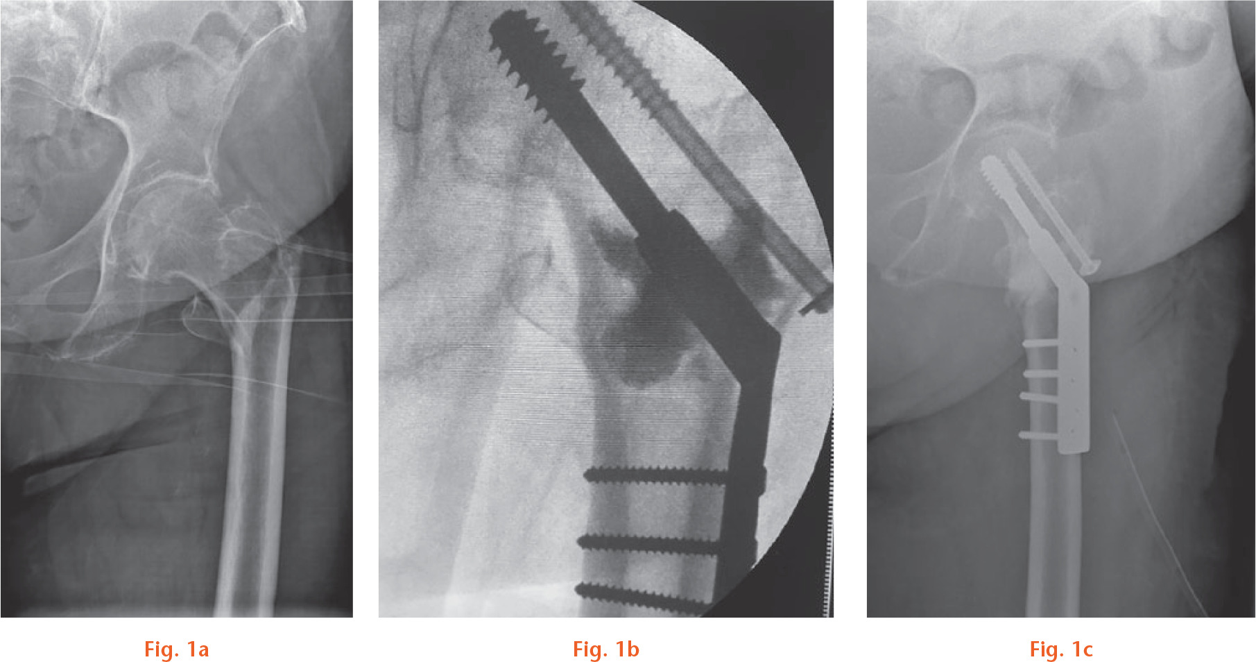  
          a) Radiograph showing an 85-year-old female patient with a trochanteric fracture (Evan class 4) in her left hip. b) Perioperative fluoroscopy of the same patient taken during injection of the vancomycin containing bone substitute. c) Radiograph of the same patient five weeks postoperatively. There was no change in fracture fixation.
        