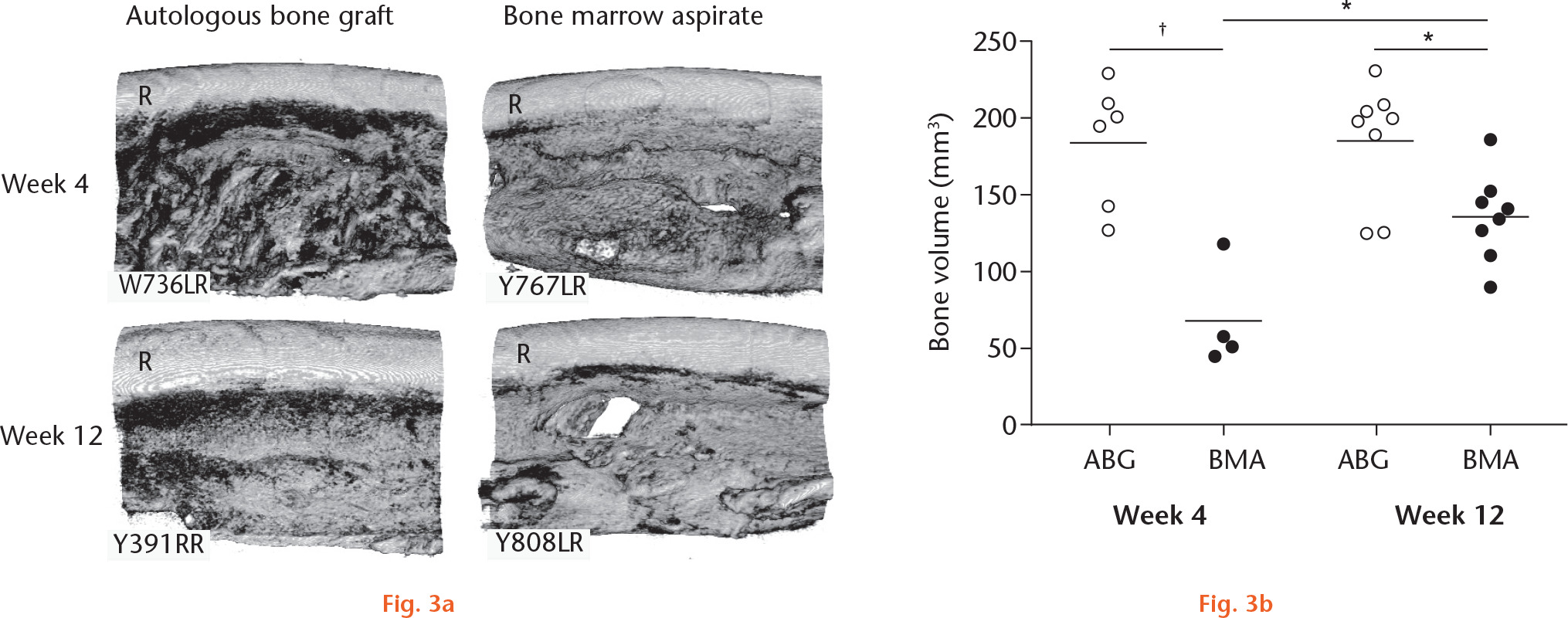 Fig. 3 
            Micro-CT assessment of rabbit ulnar defects at four and 12 weeks post-surgery. a) Representative 3D models reconstructed by Mimics software (Materialise, Leuven, Belgium). R, radius. b) Bone quantified within the 14 mm autologous bone graft (ABG)-treated and bone marrow aspirate (BMA)-treated defects (mm3). *p < 0.05; †p < 0.001.
          