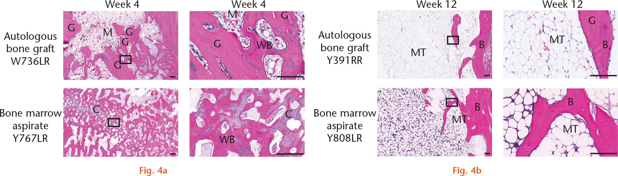 Fig. 4 
            Bone healing assessments by histology. Representative images of haematoxylin and eosin (H&E)-stained sections taken from samples approximating the mean bone volume scores from the µ-CT analyses. Images show general morphology of healing bone defects at a) post-surgical week 4 and b) week 12. Images in the right-hand column are high-power magnifications of the boxed areas in the low magnification images on the left. Scale bar represents 200 µm. G, autologous graft; M, marrow; WB, woven bone; C, chondrocytes; B, bone; MT, marrow-like tissue.
          