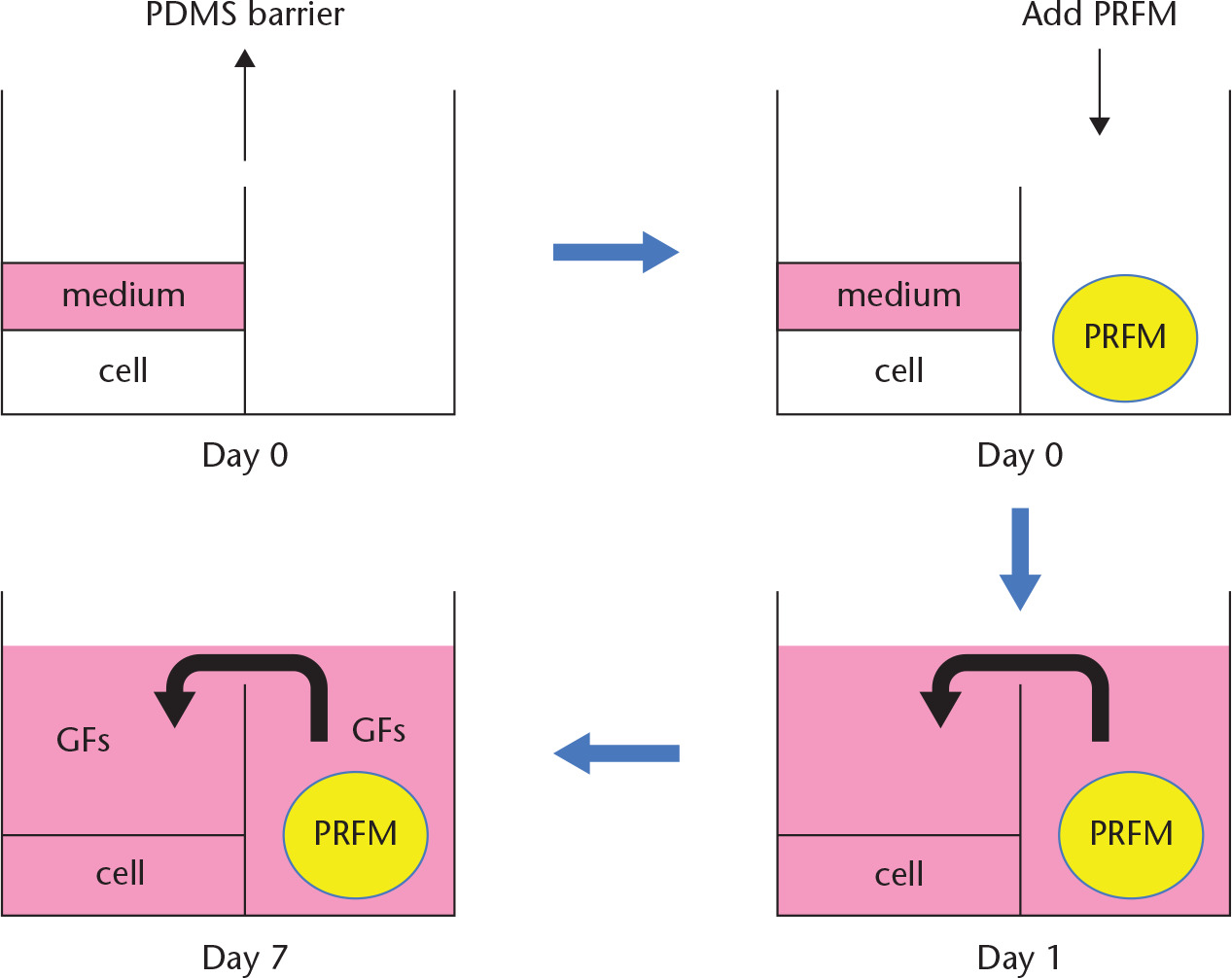 Fig. 1 
            The concept of a co-culture device to avoid the gelling effect. Top left) cell seeding in the cell chamber. Top right) platelet-rich fibrin matrix (PRFM) added into another chamber (PRFM chamber) without cell seeding. PRFM gelling may not affect the cell in the chamber because of the polydimethylsiloxane (PDMS) barrier. Bottom right) add culture medium into the PRFM chamber until it crosses over the PDMS barrier. Bottom left) growth factors in PRFM with lighter gravity dispersed in the culture medium are disseminated to the cell chamber to stimulate tenocyte proliferation. GF, growth factor.
          