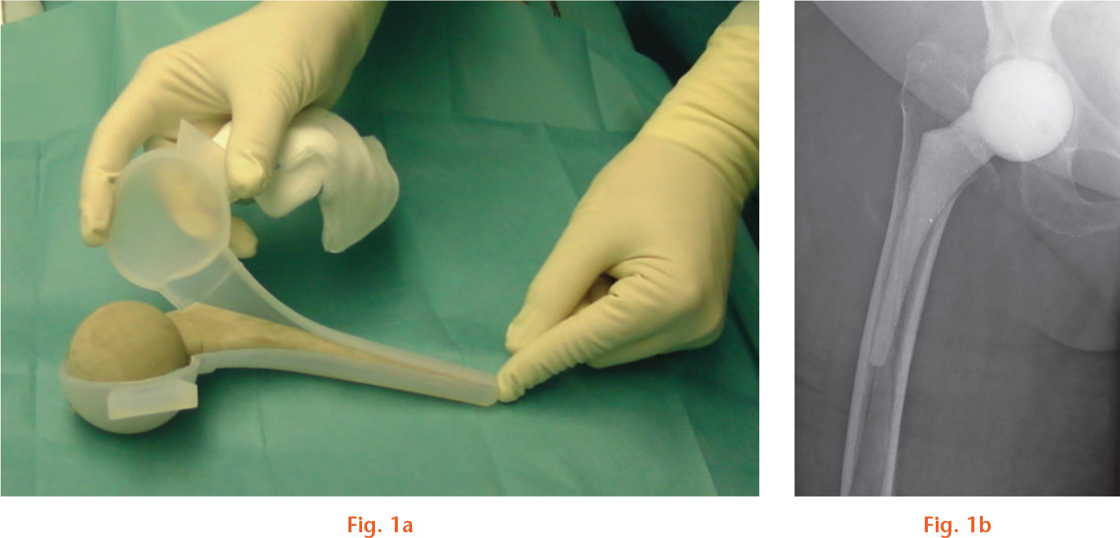 Fig. 1 
            a) Microsilver-loaded poly(methyl methacrylate) (PMMA) spacer after hardening in a preformed hip spacer mould (StageOne; Biomet). b) Postoperative radiograph control in anteroposterior view with correct placement of the microsilver-loaded PMMA spacer.
          