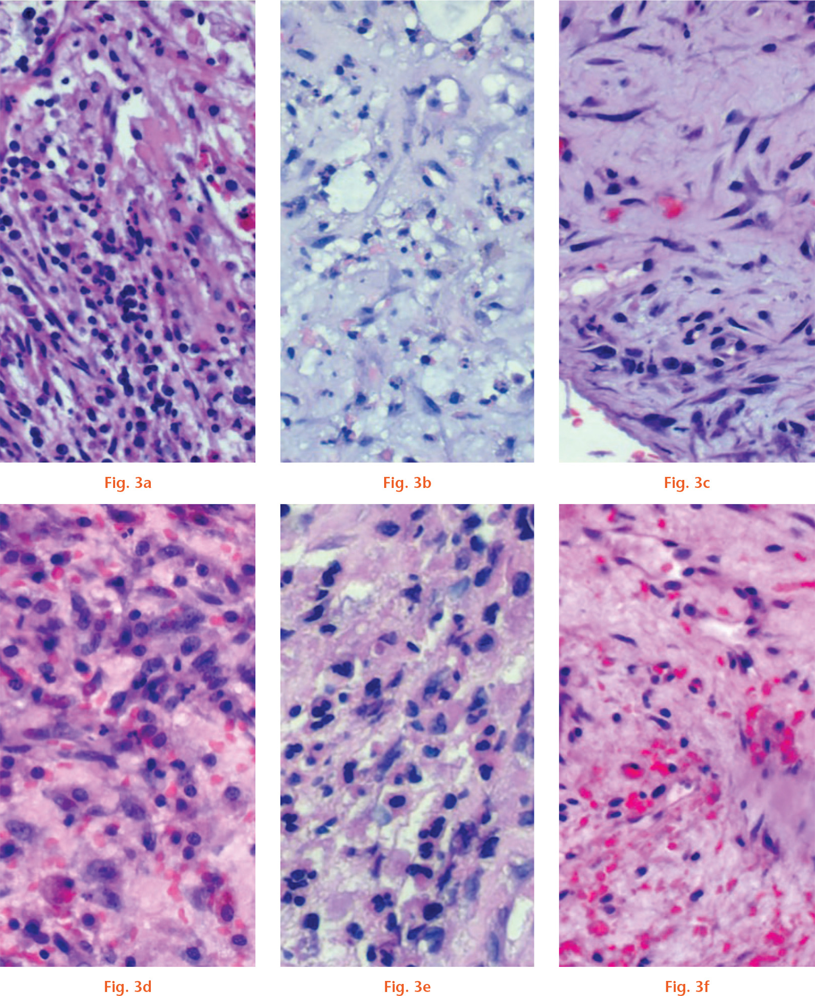 Fig. 3 
            Haematoxylin and eosin (H&E) staining and pathohistological assessment of periprosthetic/perispacer membrane in two cases. a) to c) Microsilver poly(methyl methacrylate) (PMMA) spacer first followed by silver-free PMMA spacer. d) to f) Silver-free PMMA spacer first followed by microsilver PMMA spacer. Magnification: 400×.
          