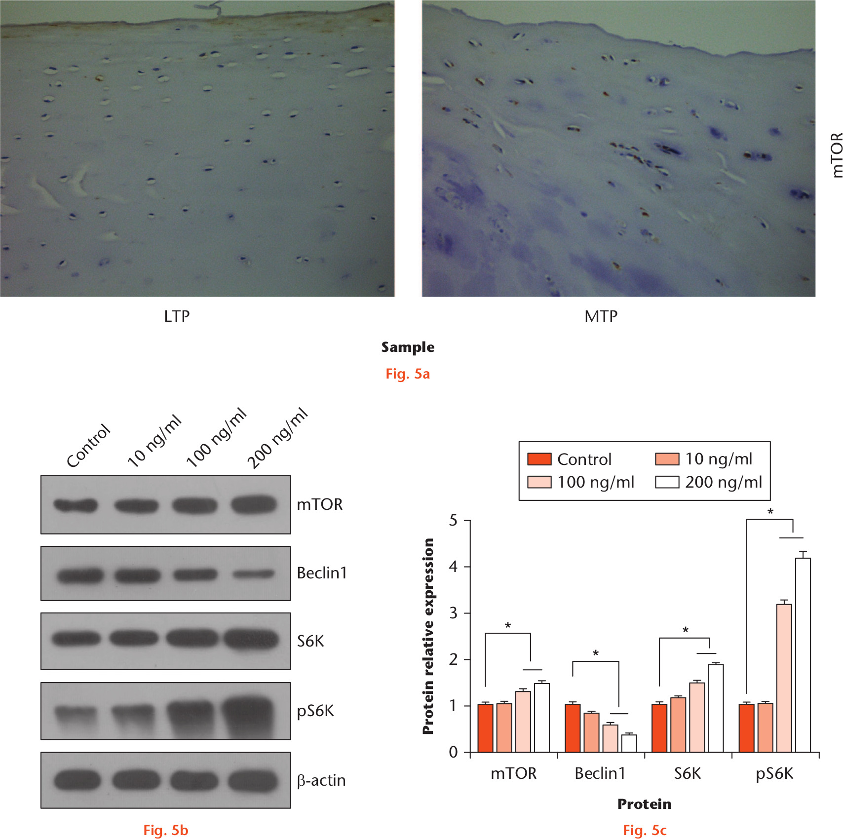 Fig. 5 
            High-dose leptin induces senescence and inhibits autophagy by activating the mammalian target of rapamycin (mTOR) pathway. a) Expression and distribution of mTOR in medial tibial plateau (MTP) and lateral tibial plateau (LTP) cartilage areas were detected. b) In chondrocytes treated by high-dose leptin, increased expression of mTOR, S6 kinase (S6K), pS6K, and Beclin1 was detected. c) Chart showing statistical analyses of expression of mTOR, S6K, and pS6K. Relative protein abundance of each blot was normalized to the grey value of β-actin. Error bars indicate the mean and standard deviation. *p < 0.05 was considered statistically significant.
          