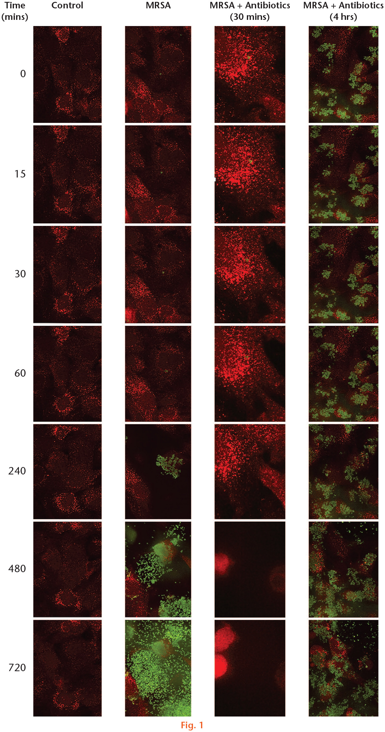 Fig. 1 
            Time-lapse microscopy images of mCherry-labelled osteoblasts (OBs) exposed to green fluorescent protein (GFP)-labelled USA300 over 14 hours. Rapid bacterial proliferation was observed in USA300-infected OBs between the first and second hours of infection. Administration of 50 μg/ml gentamicin occurred either 30 minutes or four hours postinfection. Gentamicin treatment within the first 30 minutes of infection significantly reduced bacterial burden relative to the untreated and four-hour postinfection treatment groups by one-way, repeated measures ANOVA (p = 0.025). Bacterial burden was reduced in USA300-infected OBs treated with gentamicin four hours postinfection, but to a lesser extent than that in the OBs treated within 30 minutes of infection. ANOVA, analysis of variance. MRSA, methicillin-resistant Staphylococcus aureus.
          