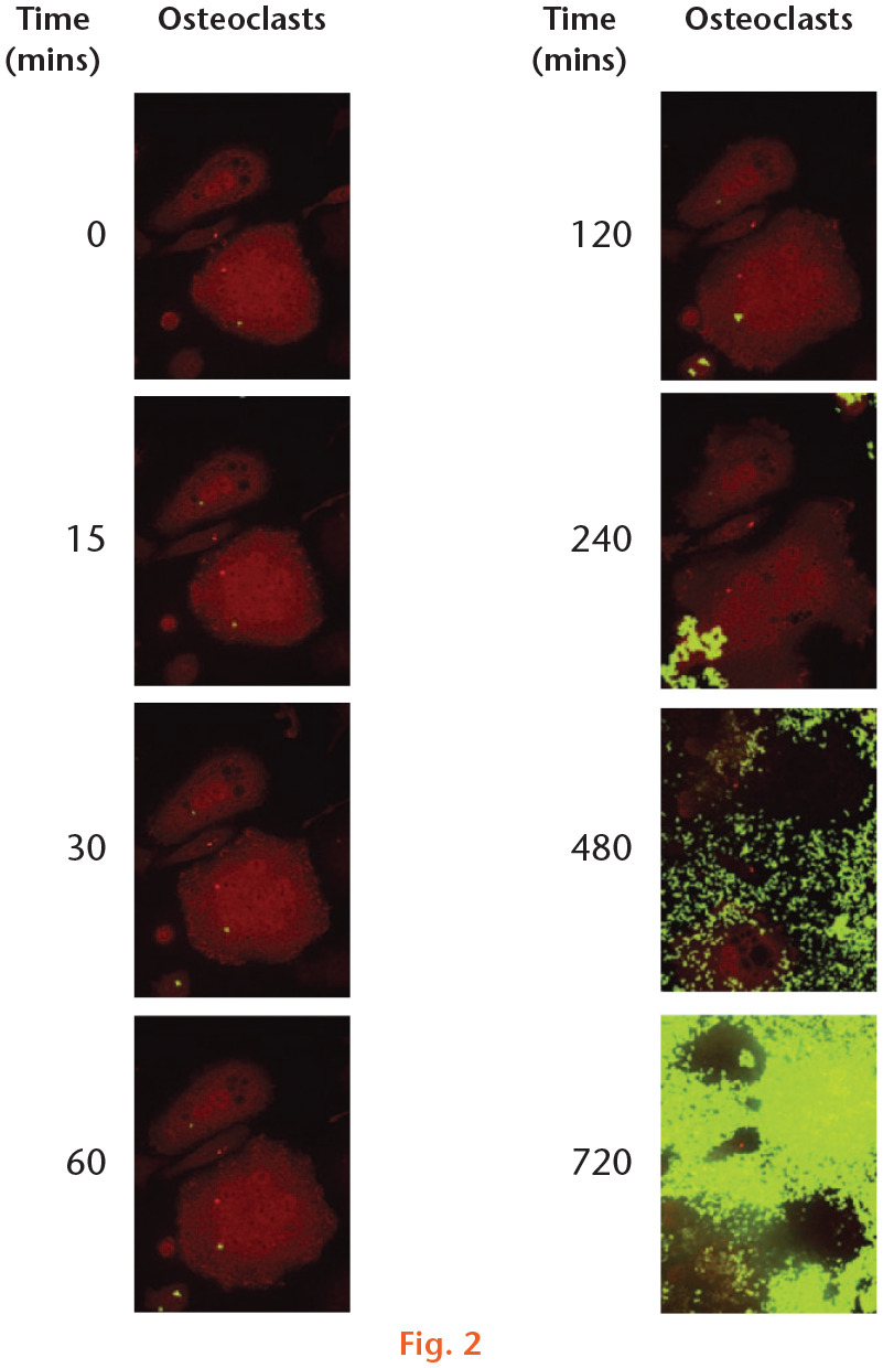 Fig. 2 
            Intracellular penetration of mCherry-labelled osteoclasts by green fluorescent protein (GFP)-labelled USA300 captured via time-lapse microscopy over 14 hours. Rapid bacterial proliferation was observed to begin between two and four hours postinfection.
          