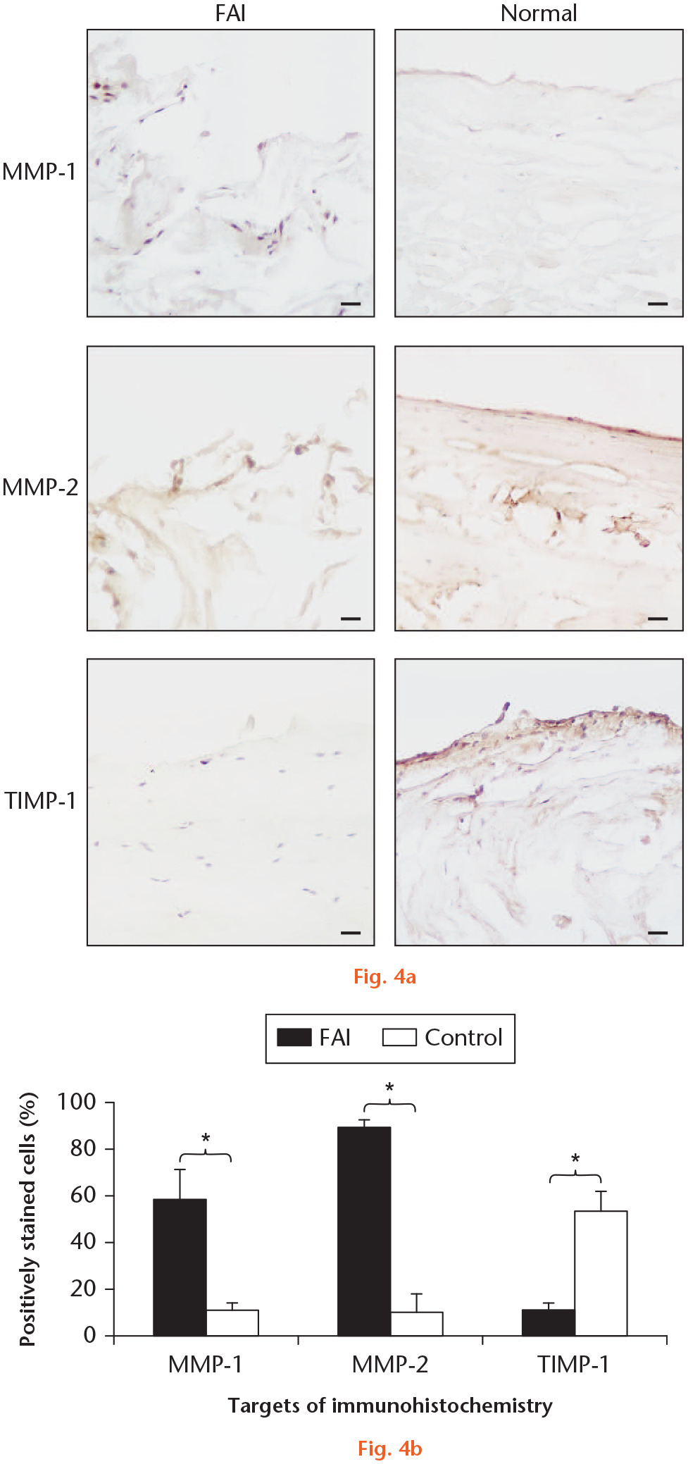 Fig. 4 
            a) Immunohistochemistry of matrix metalloproteinase (MMP)-1, MMP-2, and tissue inhibitor of metalloproteinases (TIMP)-1 in the superficial region of the normal and femoroacetabular impingement (FAI) labrums. MMP-1 positive cells are detected mostly in the superficial layer of the FAI labrum but not in the normal labrum. MMP-2 is detected both intracellularly and extracellularly in the superficial region in the FAI labrum. TIMP-1 is extensively stained in the normal labrum but not in the FAI labrum. b) The percentages of MMP-1 and MMP-2 positive cells in the superficial region of the FAI labrum are significantly increased, compared with the normal labrum. The percentage of TIMP-1 positive cells in the superficial region of the FAI labrum, however, is reduced. Bars represent 50 µm (original magnification 200×). Nuclei are counter-stained with haematoxylin. *p < 0.05.
          
