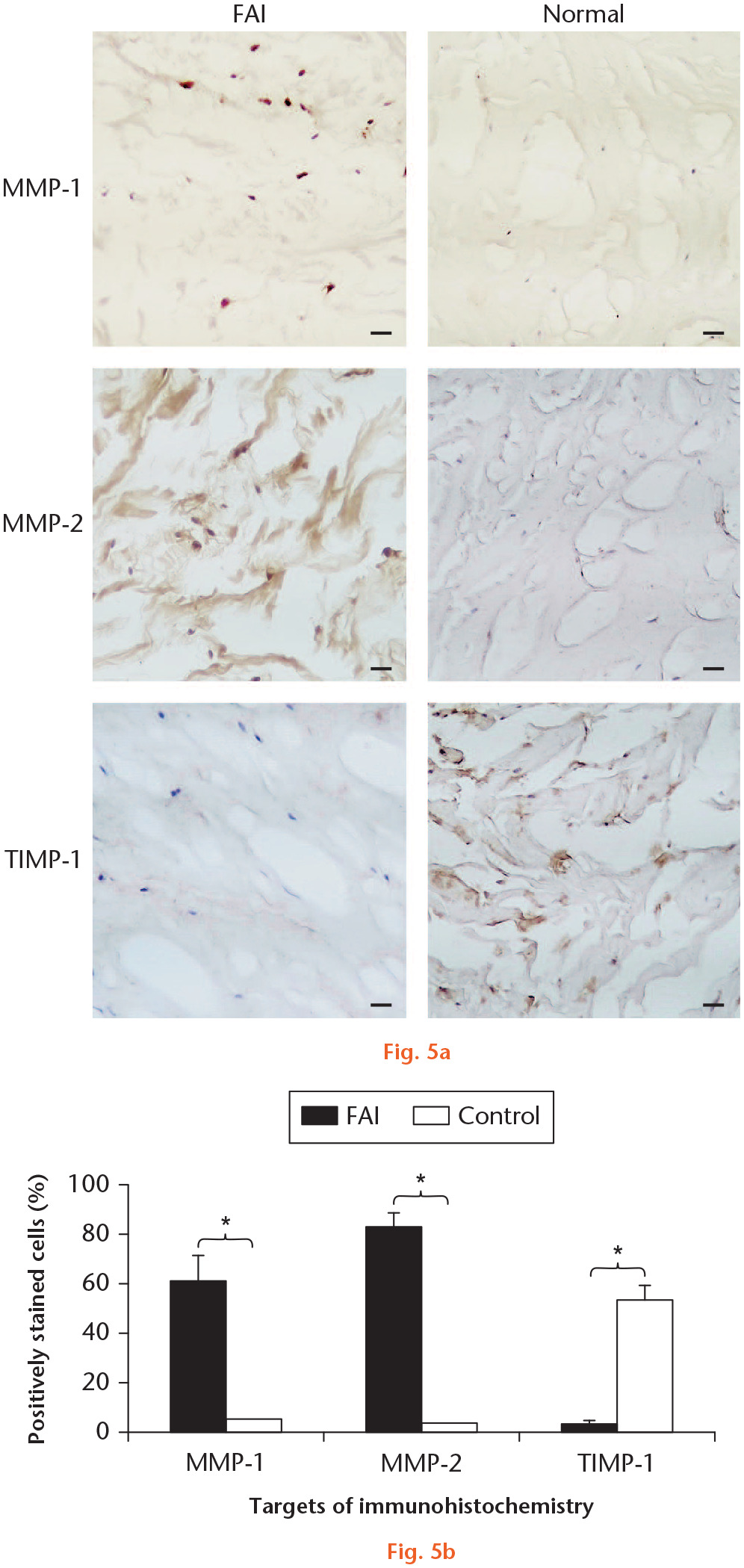 Fig. 5 
            a) Immunohistochemistry of matrix metalloproteinase (MMP)-1, MMP-2, and tissue inhibitor of metalloproteinases (TIMP)-1 in the central region of the normal and femoroacetabular impingement (FAI) labrums. Both MMP-1 and MMP-2 are detected in the central region of the FAI labrum but not in the normal controls. While MMP-1 is mostly stained intracellularly in the FAI labrum, MMP-2 is detected both intracellularly and extracellularly. TIMP-1 is detected in the normal labrum but not in the FAI labrum. b) The percentages of MMP-1 and MMP-2 positive cells in the central region of the FAI labrum are significantly greater than those in the normal labrum. The percentage of TIMP-1 positive cells in the central region of the FAI labrum is significantly reduced compared with the normal labrum. Bars represent 50 µm (original magnification 200×). Nuclei are counter-stained with haematoxylin. *p < 0.05.
          