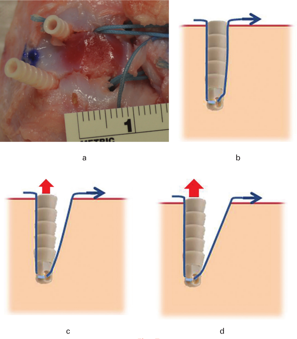 Fig. 7 
          Schematic illustration of anchor pullout. a) For the double rip-stop without medial row knots (DRS) technique, the lateral anchors were pulled out, whereas the infraspinatus tendon remained intact. b) Before loading, the suture was fixed between the anchor (BioComposite Pushlock 3.5 mm; Arthrex, Naples, Florida, USA) and the bone. c) When the infraspinatus tendon was loaded, the force generated resulted in the suture cutting the bone even further, resulting in a greater reduction in the pullout strength of the lateral anchor. d) With the progressively loading, the gap between the anchor and bone was further increased, so that the lateral anchor was easier to pullout. Red arrows denote the direction of the anchor pullout. Blue arrows denote the force applied on the sutures.
        