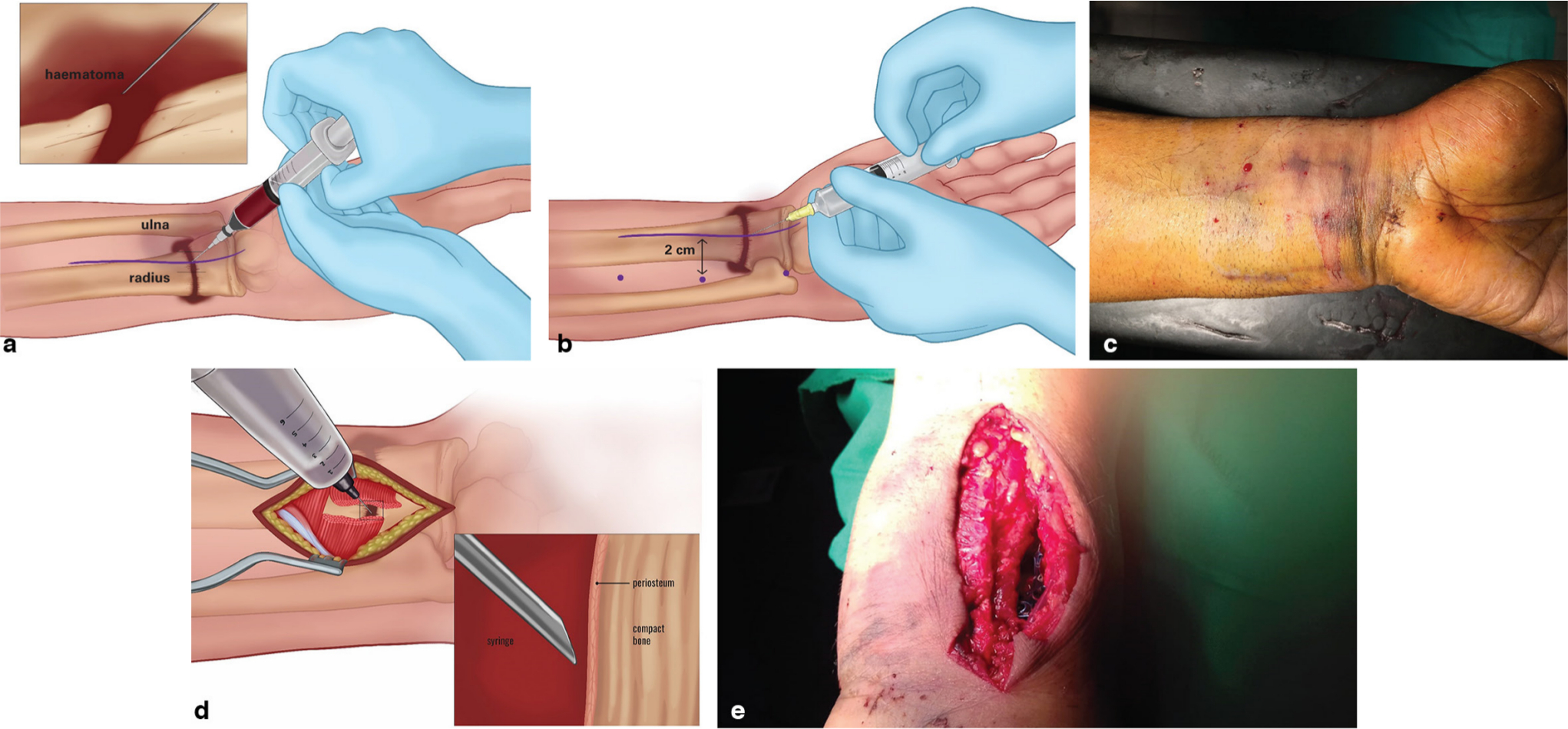 Fig. 3 
            a) Haematoma block (2% lidocaine). b) Skin infiltration (subcutaneous plane) with wide-awake local anaesthesia with no tourniquet (WALANT) solution. c) Tumescent effect of WALANT solution. d) Periosteal block. e) Final implant position and surgical exposure.
          