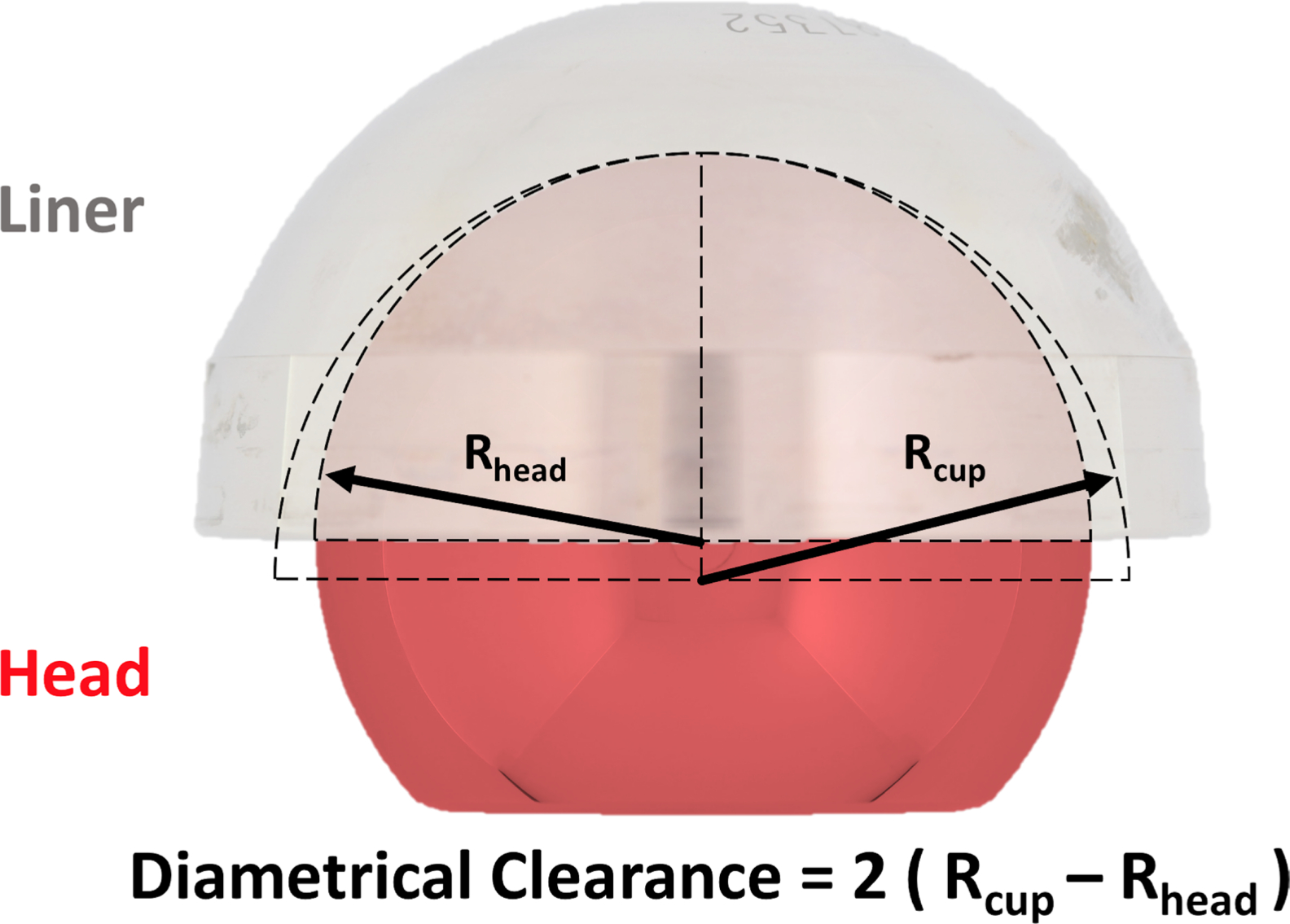 Fig. 4 
            Diametrical clearance between a head and liner component of a hip arthroplasty.
          