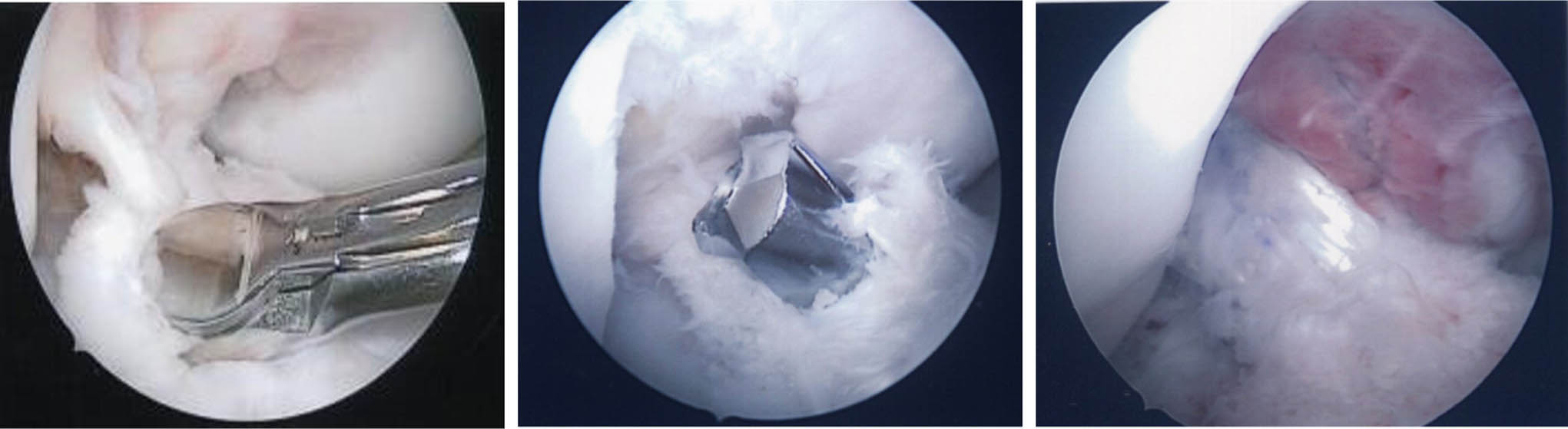 Fig. 1 
          Arthroscopic pictures of anterior cruciate ligament (ACL) remnant harvest and reconstruction. ACL remnant was harvested by arthroscopic punch (Left image). The ACL remnant was partially preserved and reamed to create bone tunnel (Middle image). The reconstructed graft was passed through the bone tunnel and surrounded by ACL remnant (Right image).
        