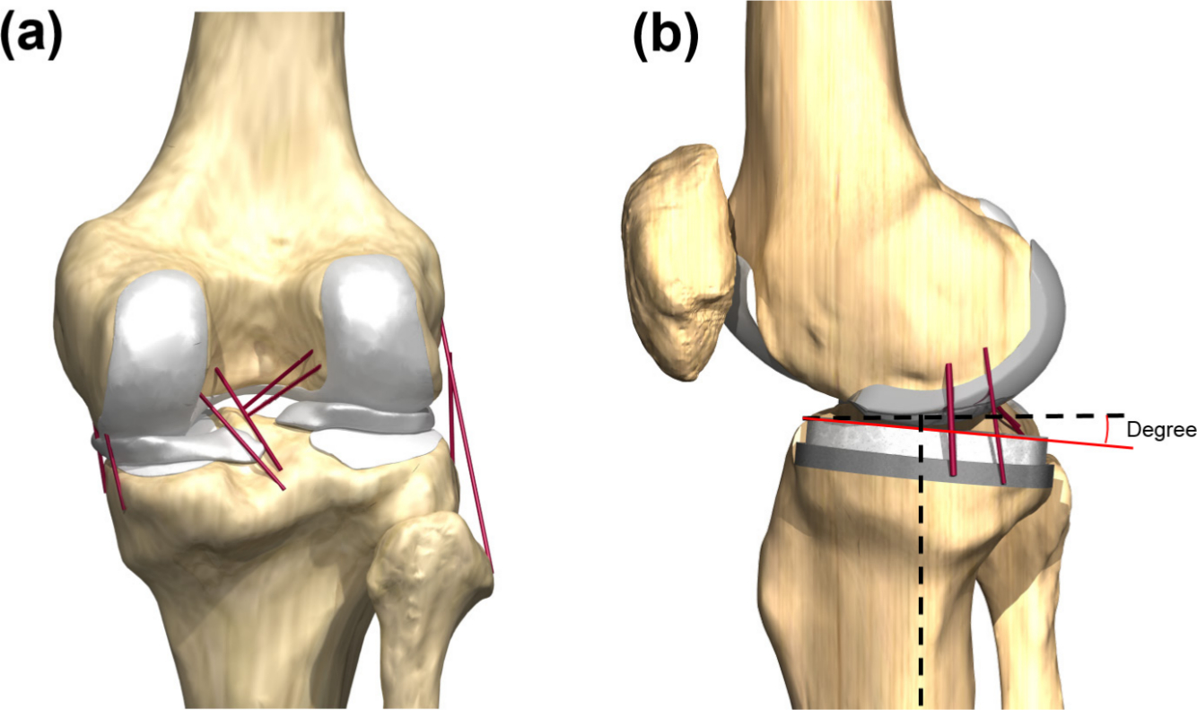 Fig. 1 
            Finite element models in analysis for a) intact and b) unicompartmental knee arthroplasty (UKA) model.
          