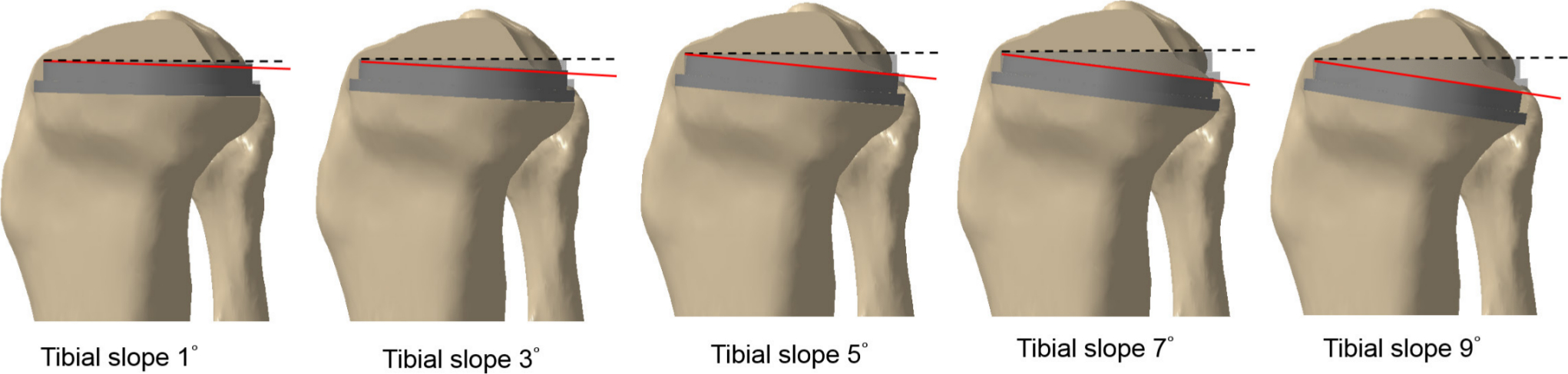 Fig. 2 
            Depiction of the posterior tibial slope of 1°, 3°, 5°, 7°, and 9°.
          