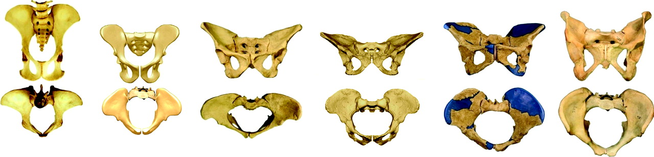 Fig. 2 
          Pelves in anteroposterior (top row) and axial views (bottom row). From left to right: Chimpanzee (Pan troglodytes), Ardi (Ardipithecusramidus, 4.4 million years ago), Lucy (Australopithecus afarensis, 3.2 million years ago), Australopithecus africanus (2.7 million years ago), Homo erectus (1.5 million years ago) and Homo sapiens. Note the birth canal first widens transversely but from Au. afarensis to H. sapiens only anteroposterior deepening occurs (adapted from Bergé and Goularas40, Lovejoy et al41 and Simpson et al42, with permission). In Darwin’s day, only the specimens far right and far left were known.
        