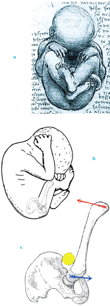Fig. 3 
            Leonardo da Vinci’s’s depiction (a &
 b) of the “position pénible” and c) the levering of the femur against the anterosuperior iliac spine. The yellow ball depicts interposed soft tissue and the red arrow depicts pressure from the uterine wall. The blue arrow shows the torsional moment that may increase anteversion while the femoral head is levered out of the acetabulum (modified fromLe Damany P.La Luxation Congenitale de la Hanche. Paris: Masson, 1923.16)
          