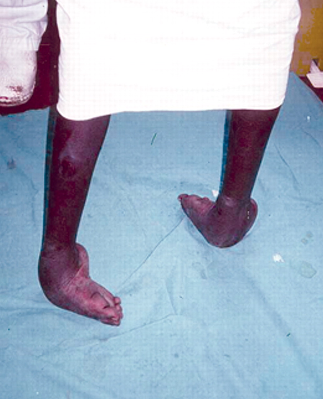 Fig. 1 
          Photograph of untreated club foot in a teenage boy resulting in severe deformity
        