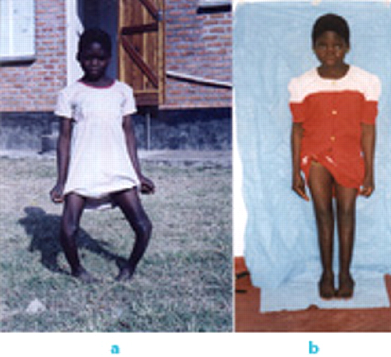 Fig. 2 
          Photographs of a) a 14-year old girl with Blount’s disease and b) after treatment with bilateral tibial osteotomy
        