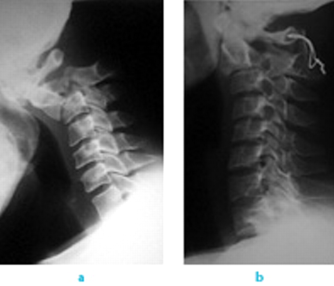 Fig. 3 
          Radiograph showing a) fracture of the pedicle of C2 sustained during a road traffic accident leading to C2/3 subluxation and b) after being treated by wiring and bone graft
        