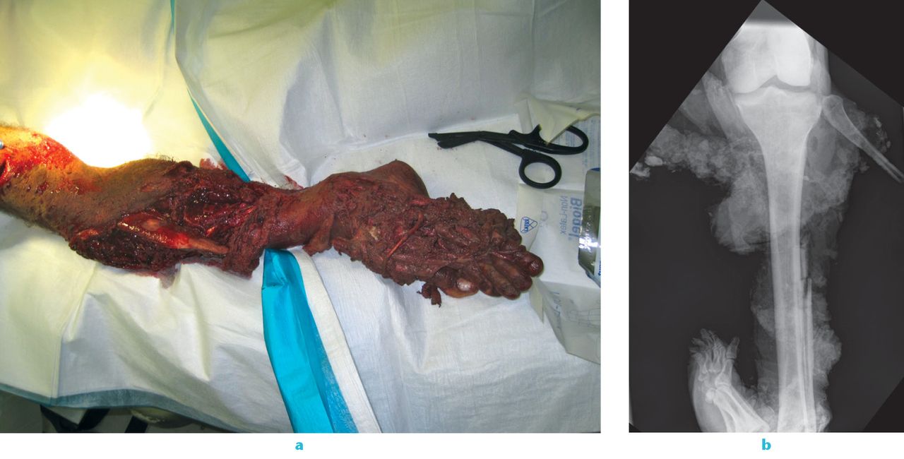 Fig. 1 
          
            Figure 1a – pre-operative clinical photograph of a mangled distal lower extremity. Figure 1b – anteroposterior radiograph of a different mangled limb. Both demonstrate the severe contamination, with osseous and soft-tissue injuries, that are associated with blasts from improvised explosive devices. Both limbs required immediate transtibial amputation during the first debridement and irrigation procedure.
        