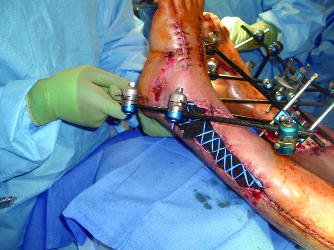 Fig. 3 
          Clinical photograph of an active-duty service member who sustained bilateral limb-threatening tibial fractures after a blast injury. The fractures were provisionally stabilised with external fixators. The segmental bone loss in his right tibia, after thorough irrigation and debridement, had antibiotic beads placed within the defect. The left lower extremity was treated with vacuum-assisted closure and a “Jacob’s Ladder” large vessel loop configuration applied to the skin margins by skin staples in order to initially treat the associated soft-tissue loss.
        