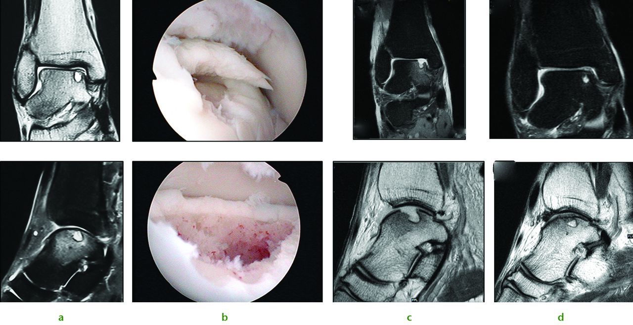 Fig. 3 
            Images of a 36-year-old man who sustained chondral injury. Figure 4a – ankle joint showing medial talar dome chondral lesion with underlying subchondral cyst. Figure 4b – views following subchondral drilling around the lesion and into the cyst. Figure 4c – post-operative MRI scan following subchondral drilling (Sagittal PD and Coronal PDFS). Figure 4d – MRI scans at nine months showing healing of the chondral lesion.
          