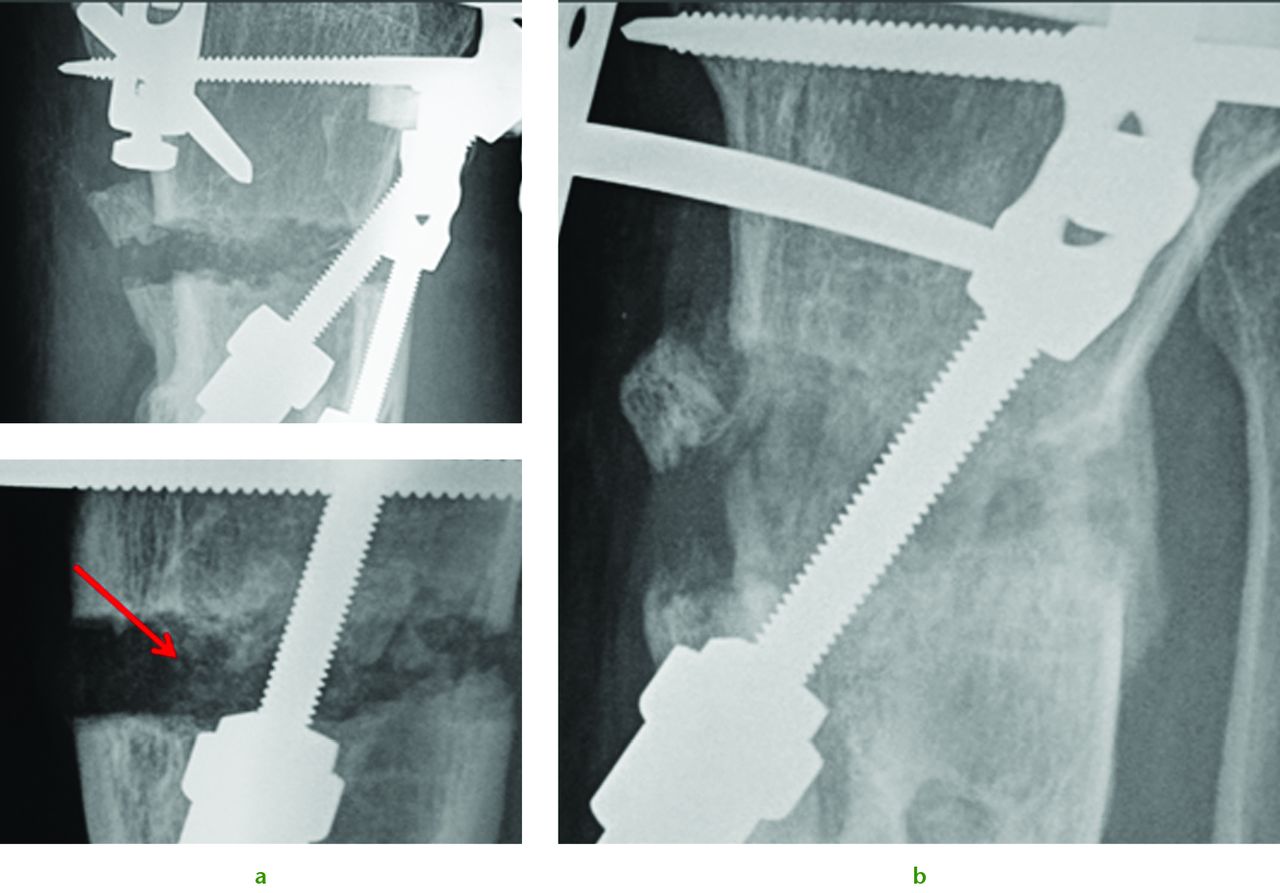 Fig. 4 
            Radiographs of a 51-year-old man who presented with left knee pain and instability, showing a) distraction osteogenesis and evidence of callus formation one week after injection of PBSC into corticotomy site (red arrow), and b) significant growth of new bone after four months.
          