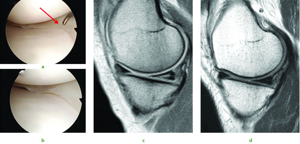 Fig. 5 
            A 43-year-old woman presented with a chondral injury of her left knee accompanied by symptomatic intra-substance tear of the medial meniscus. Figure 5a – intra-operative view of the posterior aspect of the medial meniscus showing intact surfaces. Figure 5b – arthroscopic view after multiple needling into the posterior aspect of the medial meniscus. Figure 5c – pre-operative MRI scan showing intra-substance tear of the posterior aspect of the medial meniscus. Figure 5d – MRI scan after three years showing complete healing of the meniscal tear.
          