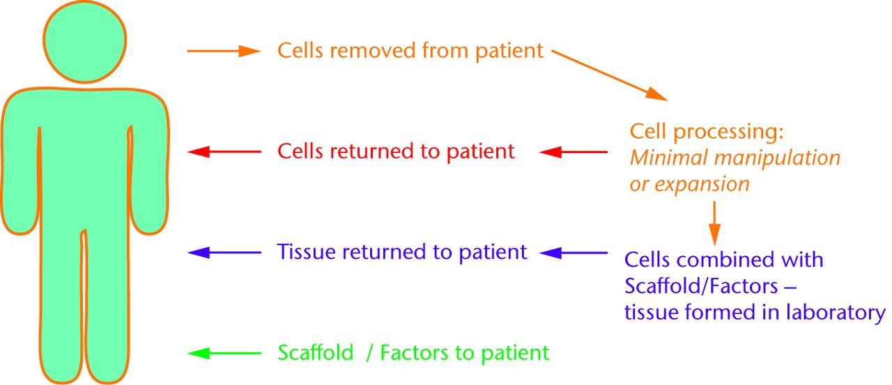 Fig. 3 
          Schematic showing some of the possible ways that cells (e.g. mesenchymal stem cells) could be used for tissue regeneration. Cells removed from the patient can be utilised for tissue synthesis back in the patient (red) or in the laboratory (purple). Another approach would use scaffolds and factors to work with cells in the patient without removal (green).
        