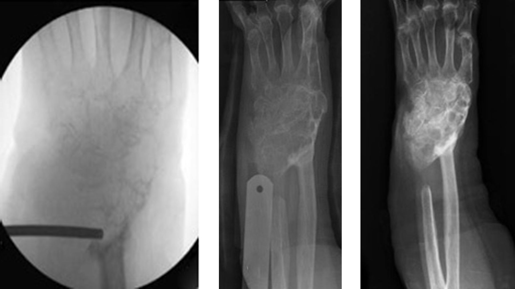 Fig. 1 
        A 79-year-old woman presented with extensive recurrence of a GCT involving the distal radius and carpus. The biopsy radiograph shows no discernible bone structure remaining. Within six weeks of starting denosumab, ossification was apparent and by three months she had dense calcification and was pain free.
      