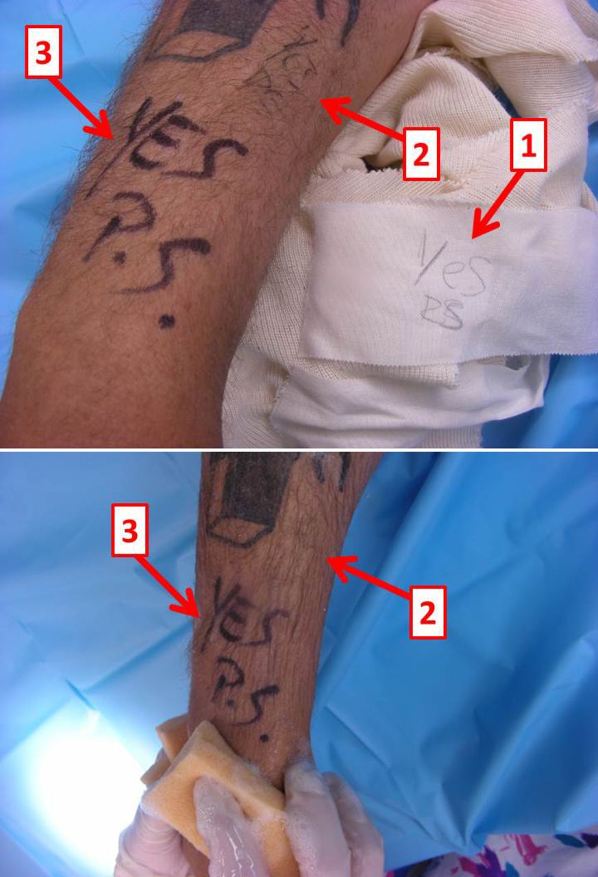 Fig. 2 
          Photographs showing the ‘dos and don’ts’ of technical options for surgical site marking.Top image: this patient was scheduled for a surgical procedure on the right forearm. 1) The intern marked and initialed the site on the dressing, which came off prior to surgery. 2) The resident corrected the mistake by marking the surgical site on skin, using a regular pen. Neither the marking nor the initials is legible. 3) The site was again marked and initialed by the attending surgeon with a permanent marker. Bottom image: during the surgical preparation, the site marking with a regular pen 2) was washed off immediately, whereas the permanent marker 3) remained visible throughout the surgical preparation. This example emphasises the crucial importance of using a permanent marker, large and legible letters, and to sign the marking with the surgeon’s initials. “YES” is the designated, standardised identifier for the correct surgical site at Denver Health Medical Center.
        