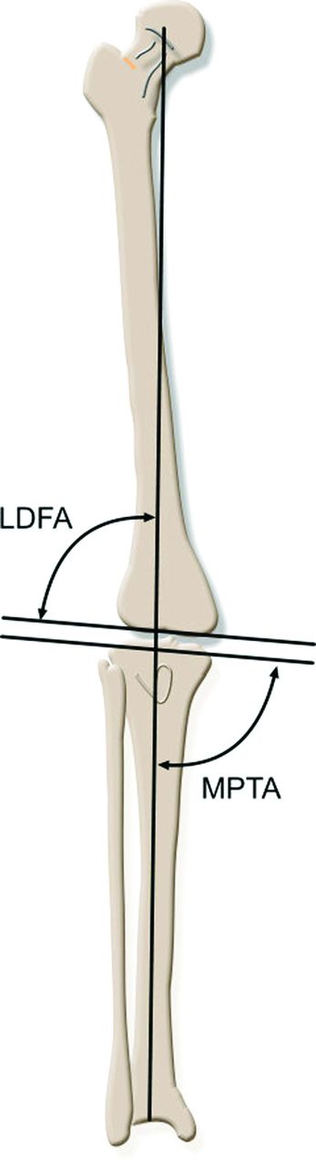 Fig. 3 
          Lateral Distal Femoral Angle (LDFA) and Medial Proximal Tibial Angle (MPTA), demonstrating the natural joint line obliquity.
        