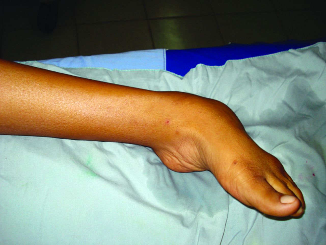 Fig. 1 
        Severe, untreated talipes in a 15-year-old girl.
      