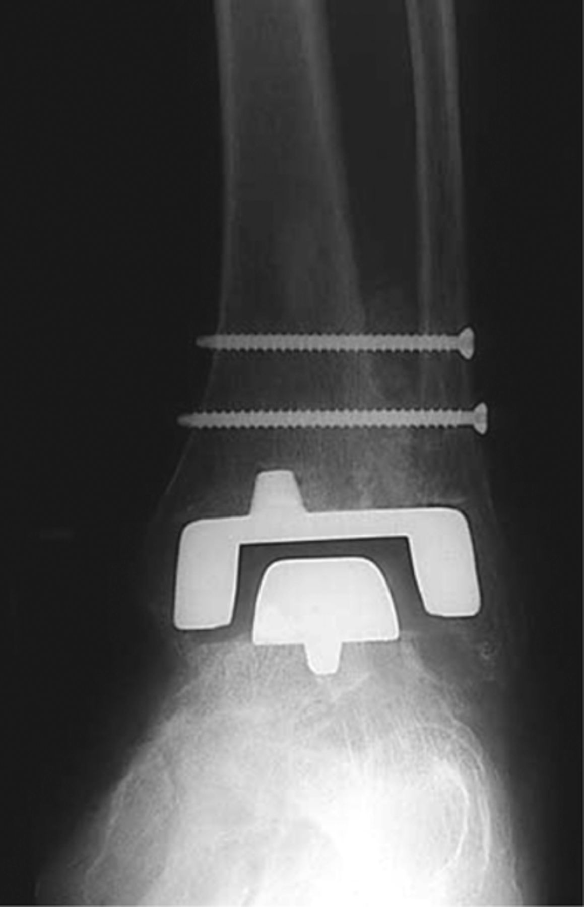Fig. 1 
          Agility ankle replacement. A fixed bearing design with fusion of the distal fibula and tibia. Picture courtesy of DePuy Orthopaedics, Inc. (West Chester, Pennsylvania, USA).
        
