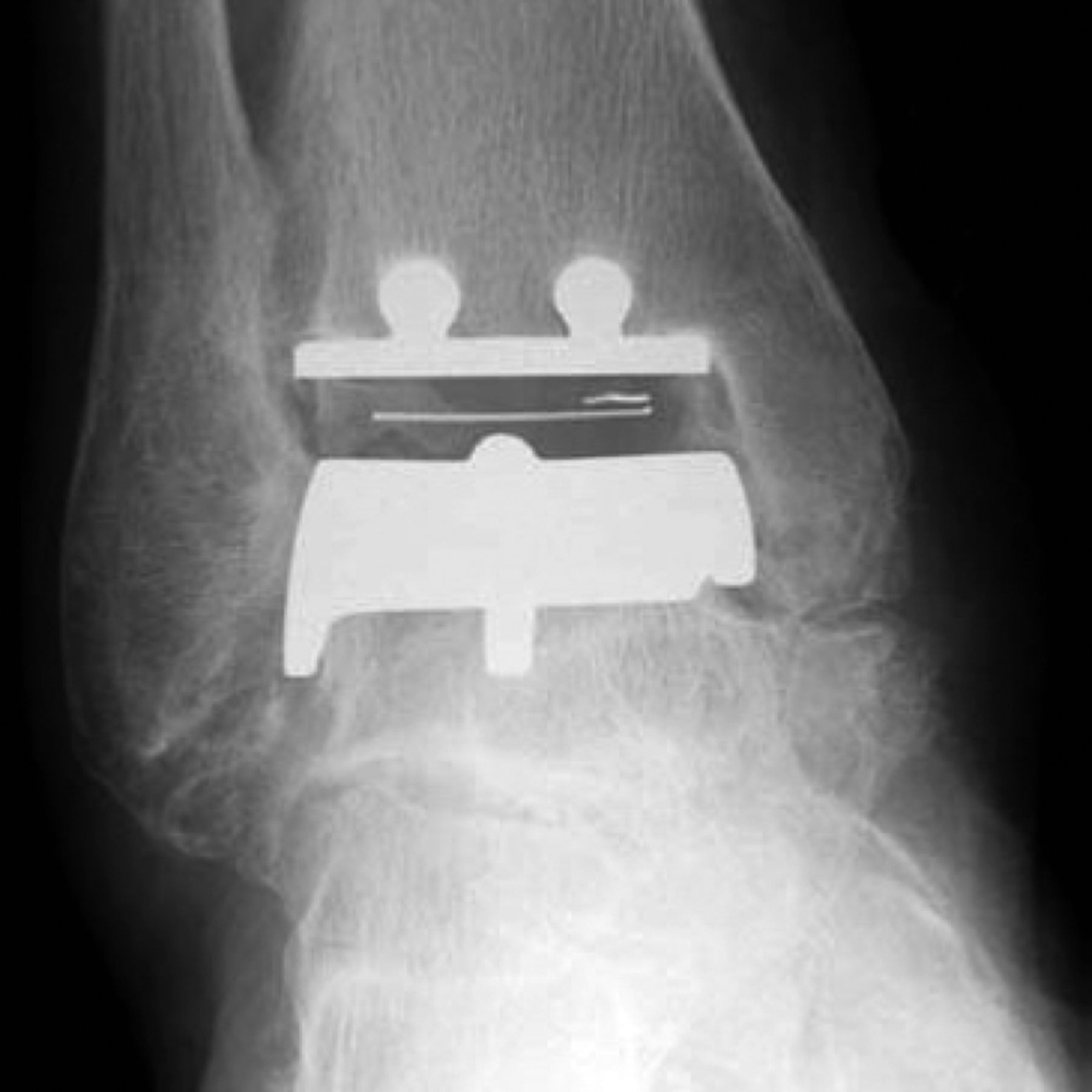 Fig. 4 
          STAR total ankle replacement. A mobile bearing design with parallel dowel fixation in the tibia.
        