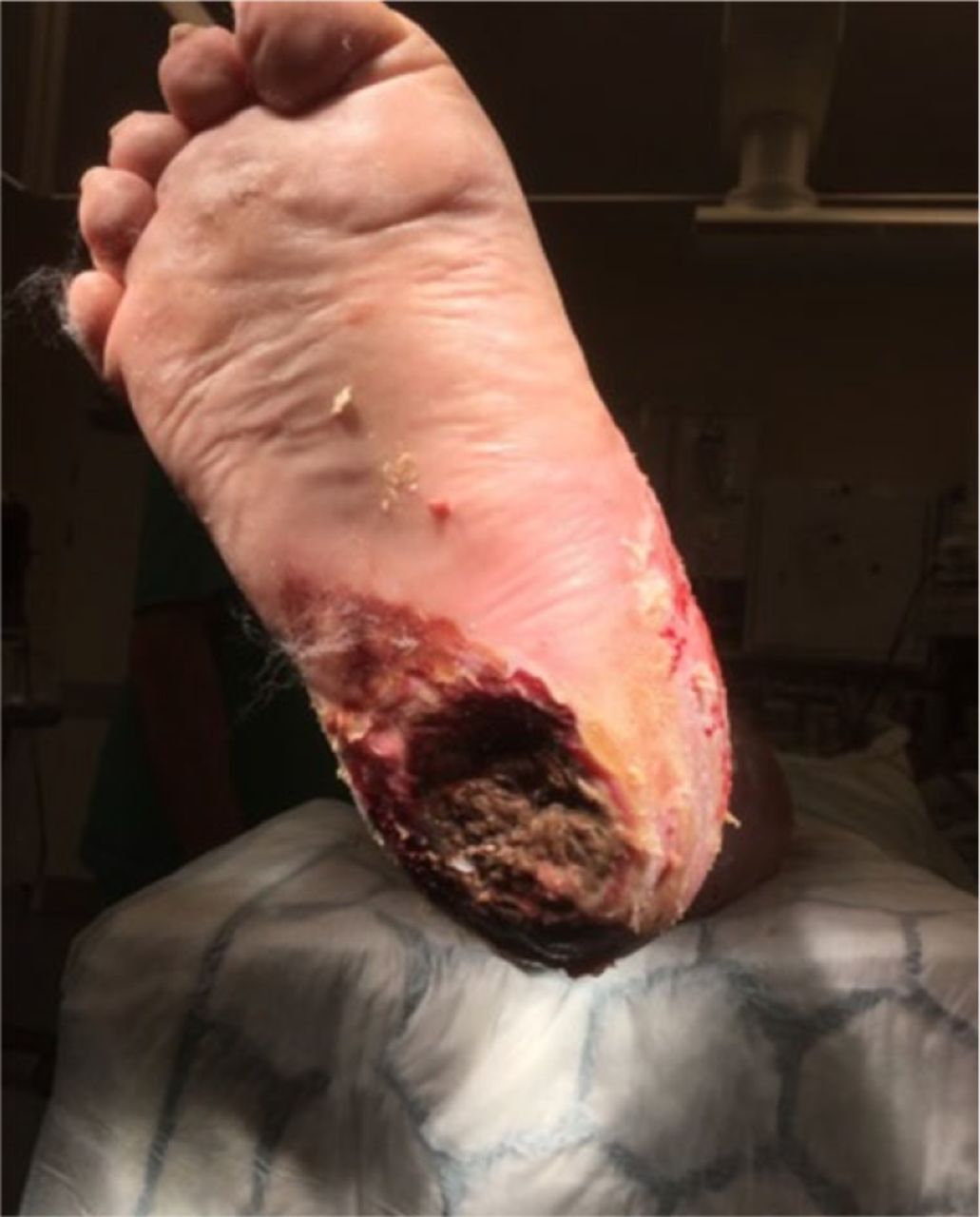 Fig. 1 
          Necrotic diabetic foot ulcer of calcaneum.
        