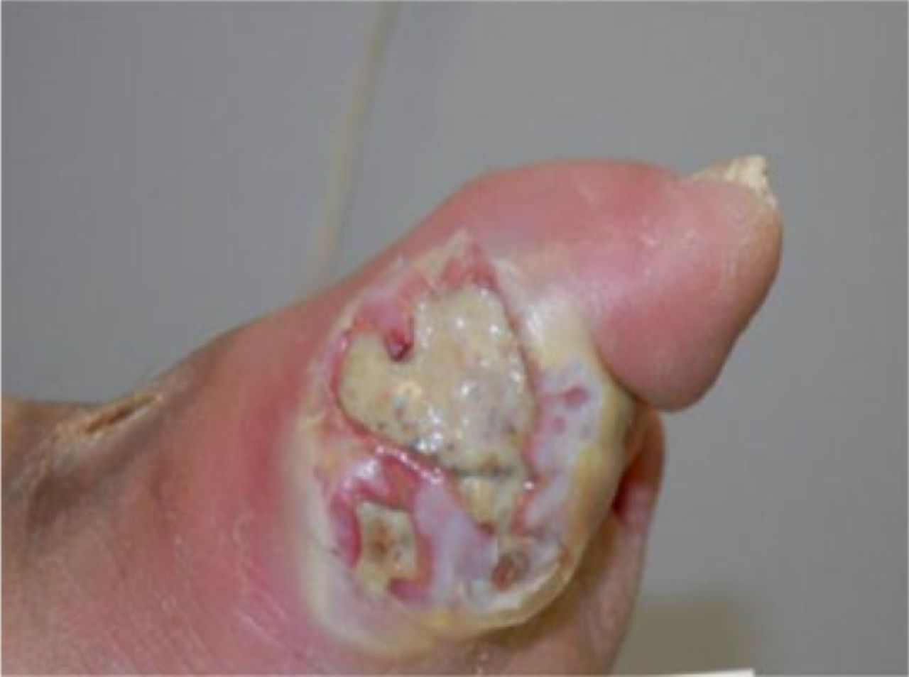 Fig. 2 
            A forefoot ulcer.
          
