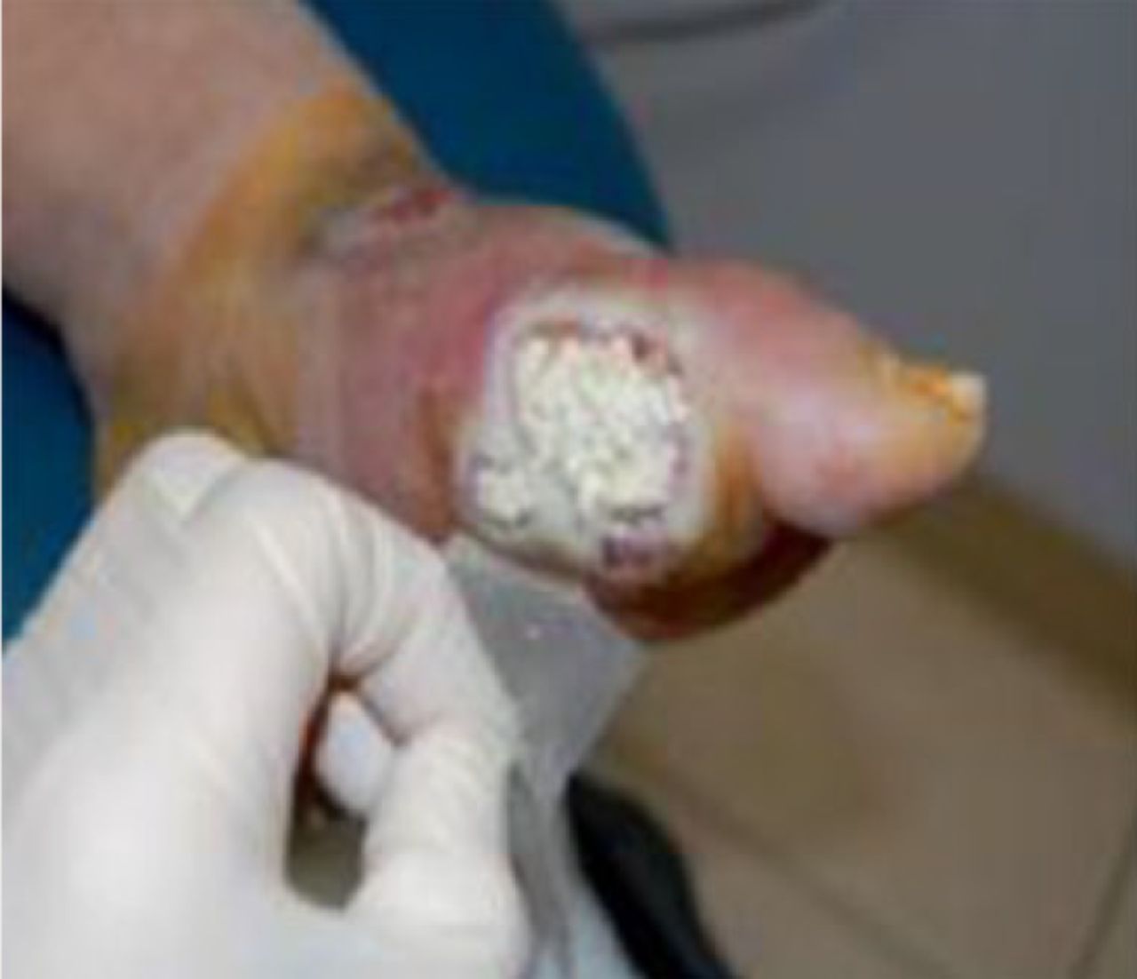 Fig. 3 
            Ulcer post-debridement and application of Stimulan.
          