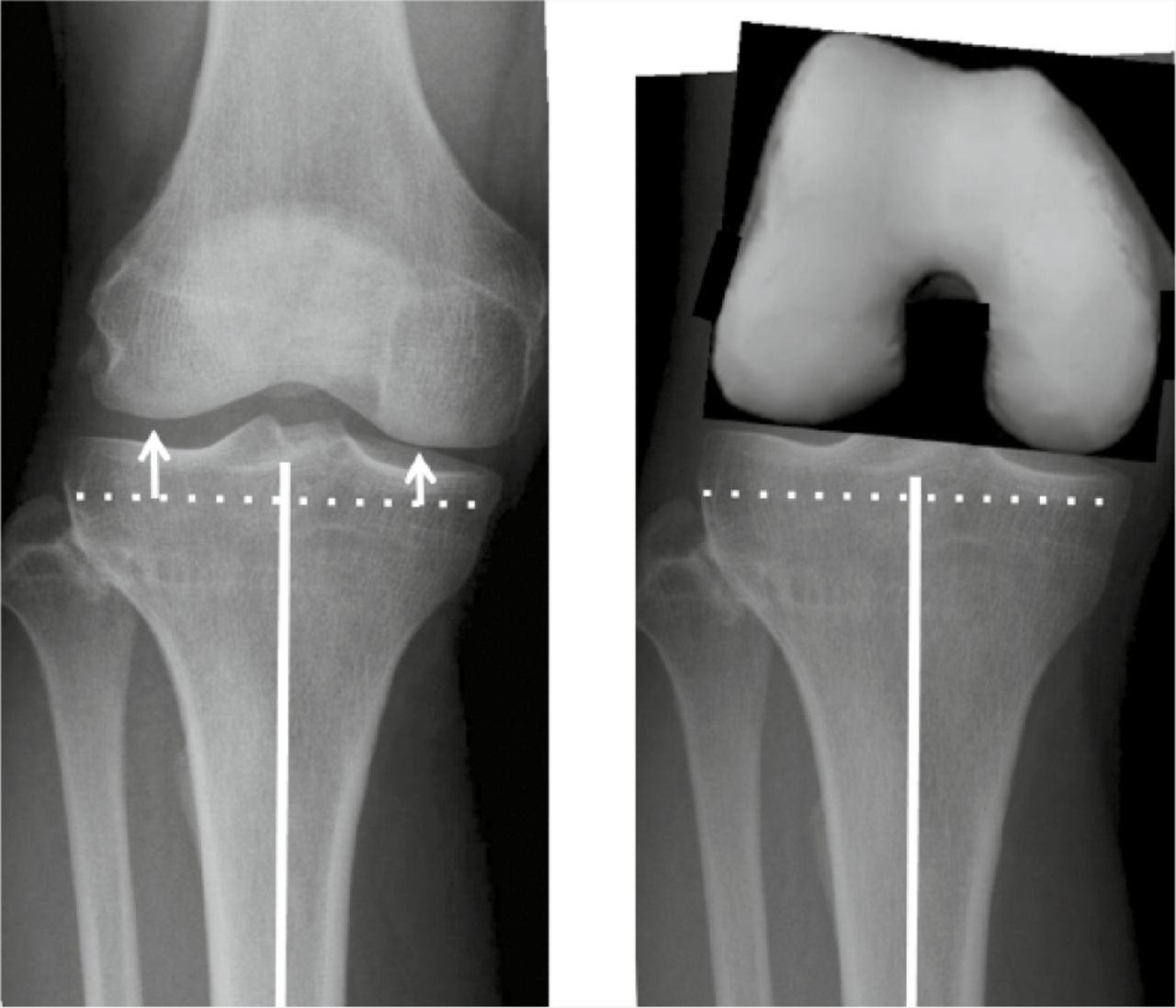 Fig. 10 
            The larger radius medial femoral condyle articulates with the lower medial tibial plateau in extension (left) and flexion (right). A tibial resection perpendicular to the tibial axis (dotted line) resects less bone from the medial tibia. In flexion the femoral component is conventionally placed in 3° external rotation relative to the posterior femoral condyles in order to compensate, however, this is only accurate for the typical patient and not every patient as there is individual variation in the discrepancy between the joint level heights.
          